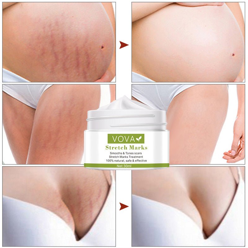 Anti-Stretch Marks Scar Removal Cream